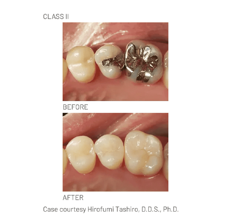 Resina Composite Palfique LX5 Tokuyama - Imagen 3
